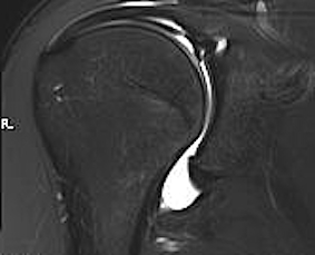 Perthes Lesion MRI 2